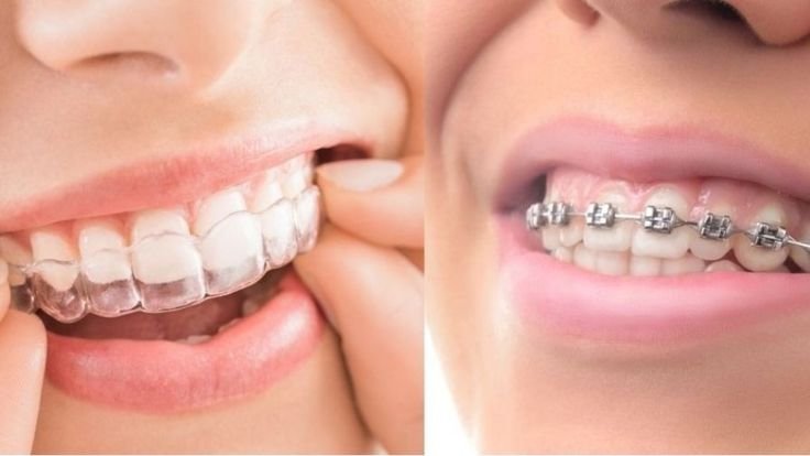 Braces vs Clear Aligners