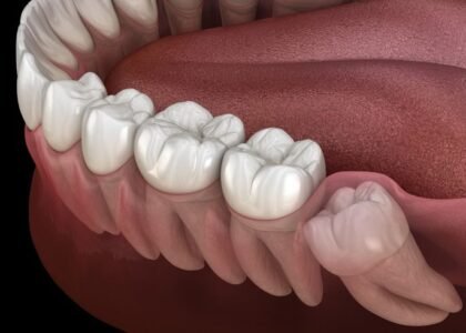 Wisdom Teeth Home Remedies