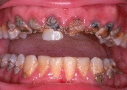 Critical Causes Behind Unhealthy Teeth