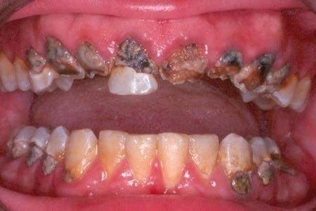 Critical Causes Behind Unhealthy Teeth
