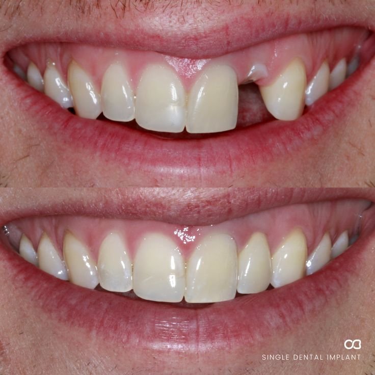 Dental Implants: 5 Ultimate Myths You Should Avoid Dental Implants ultimate Myths You Should Avoid