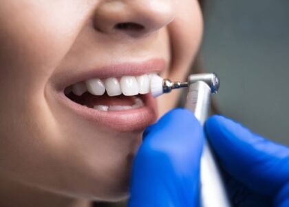 Teeth Cleaning Charges Benefits
