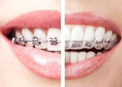 Braces vs Clear Aligners