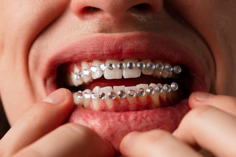 metal Braces Orthodontic Treatment