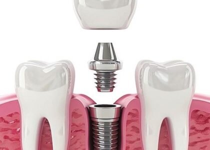 Dental implants