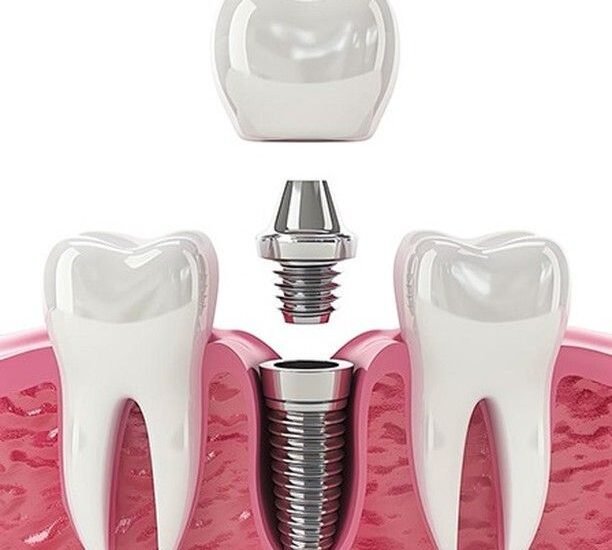 Dental implants