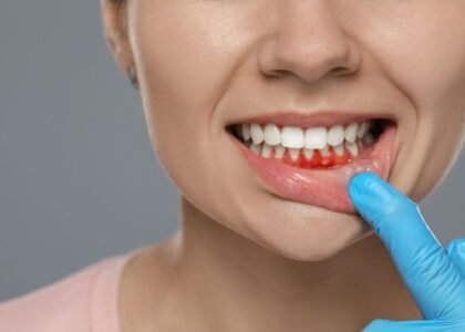 Gum Depigmentation Incredible Results