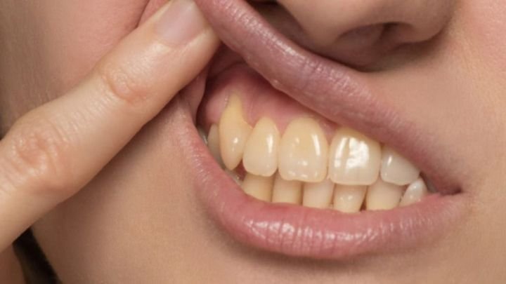 Yellow Teeth Reasons 