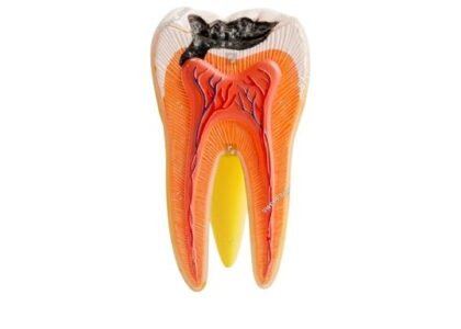Dental caries zones