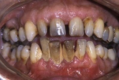 Yellow Teeth Reason for Smoking and Tobacco Stains