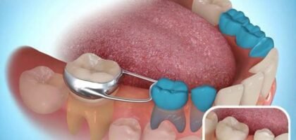 what are space maintainers space maintainers are…