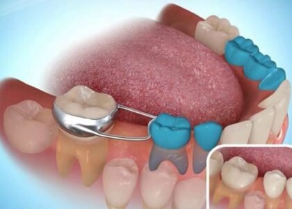 what are space maintainers space maintainers are…