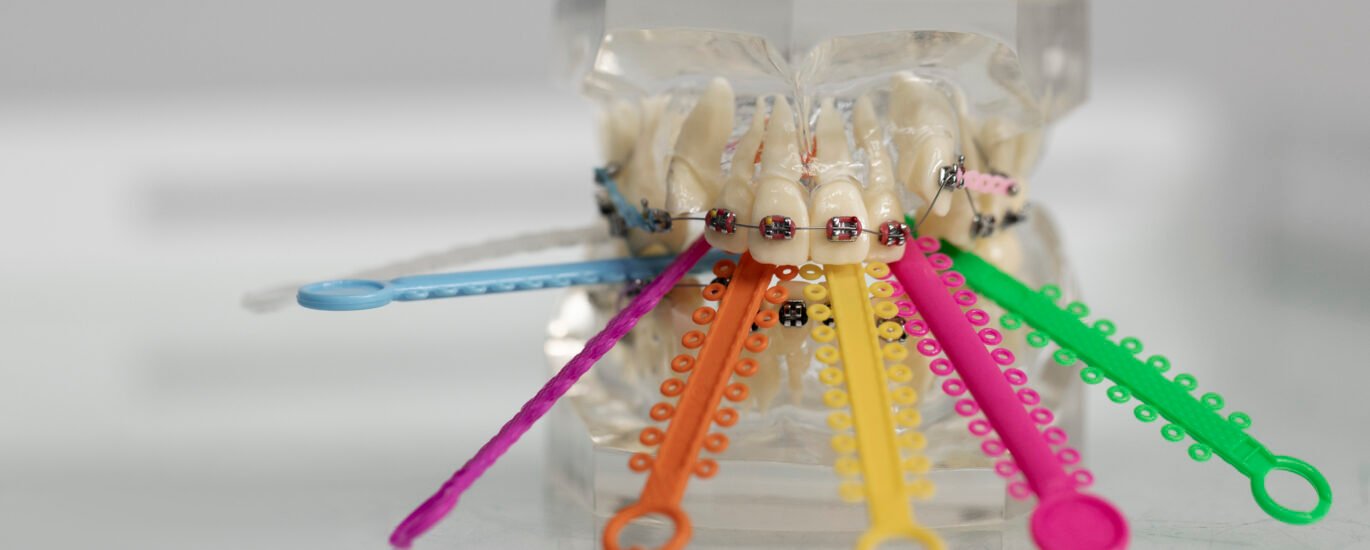 Dental Clips for Teeth Surprising Facts