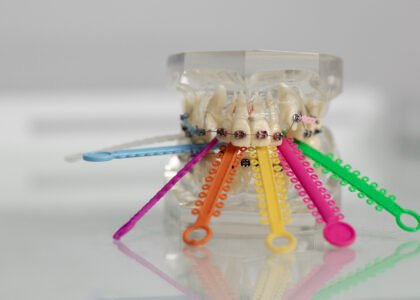 Dental Clips for Teeth Surprising Facts