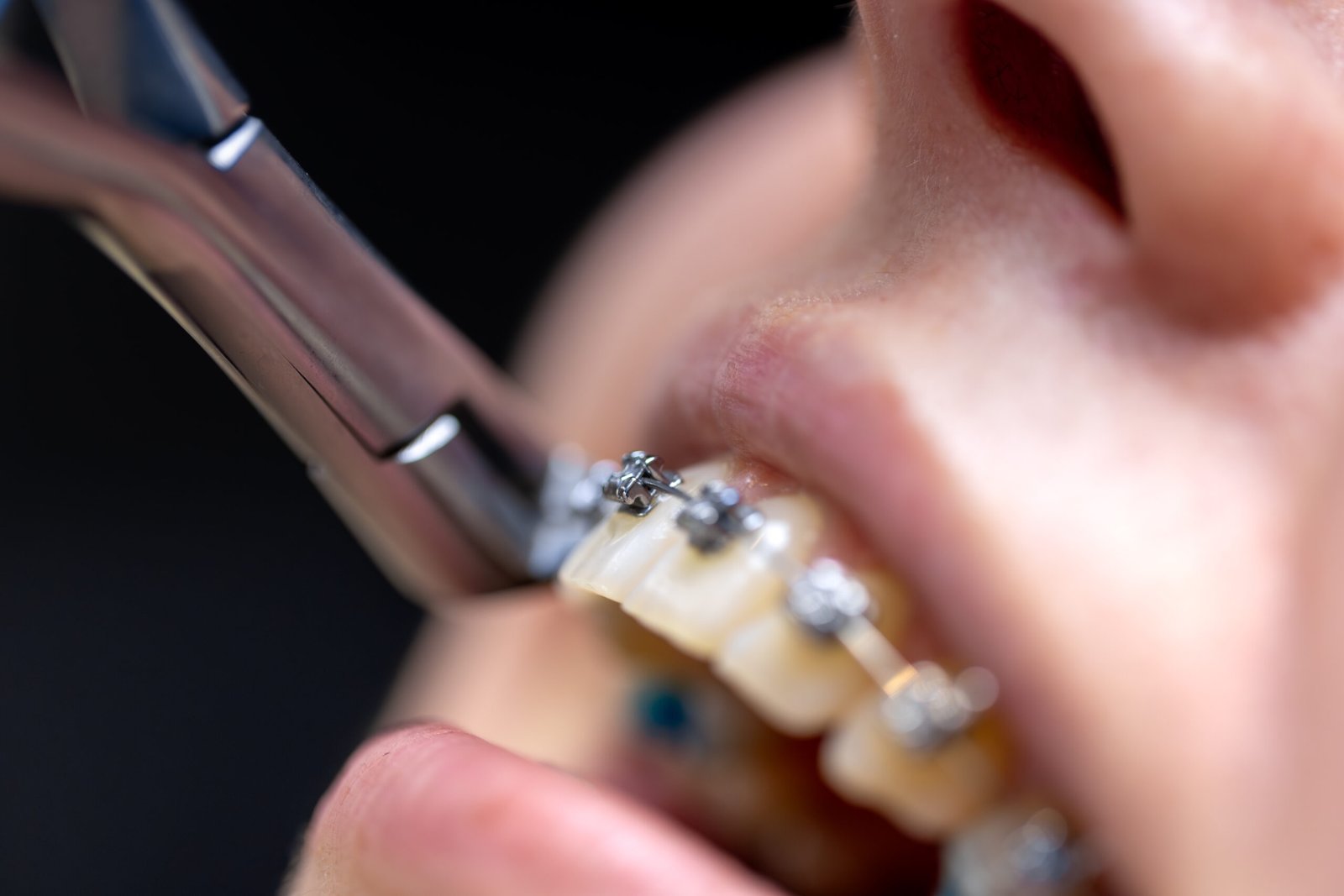 Dental Clips for Teeth Surprising Facts