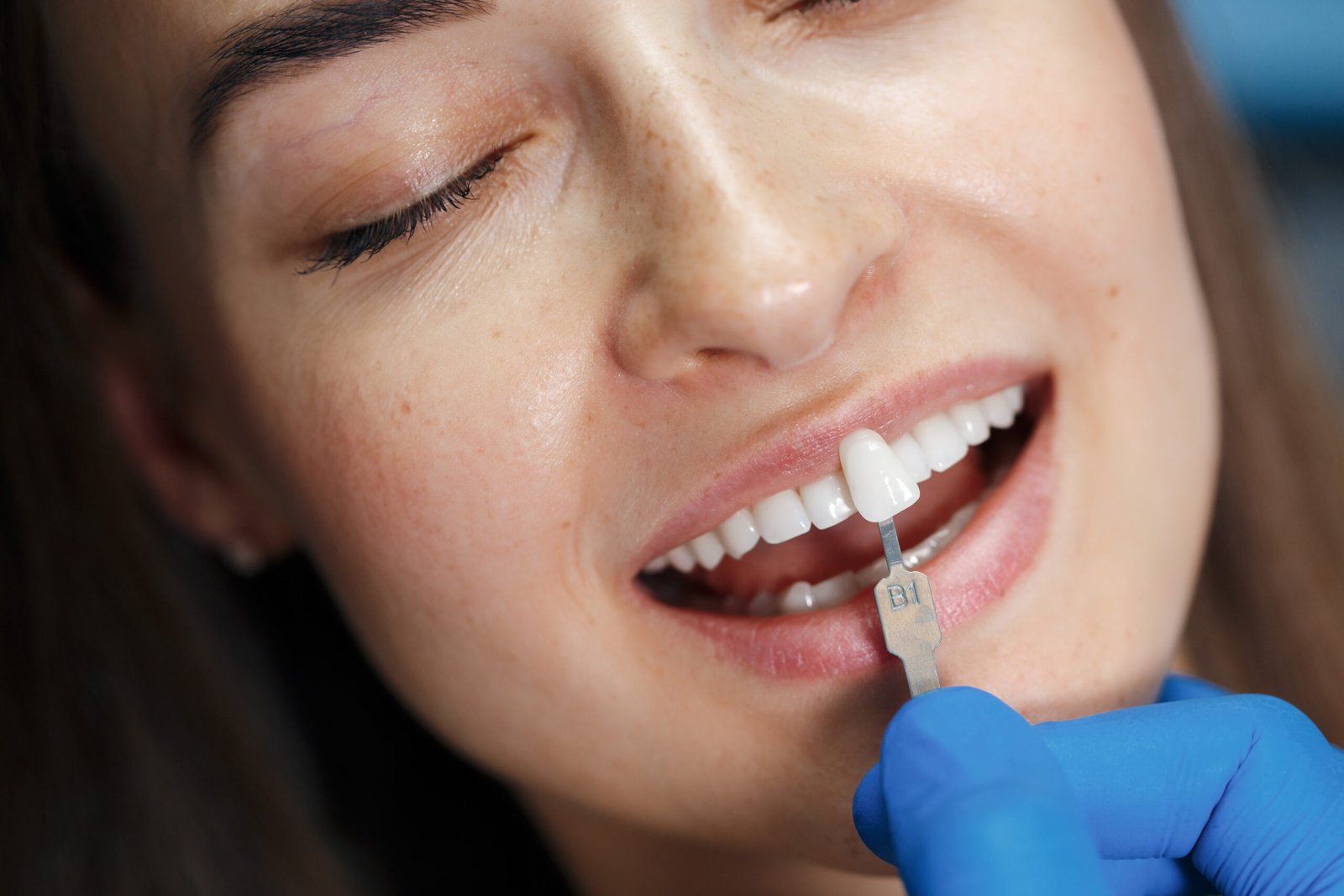 cosmetic dentistry procedures Tooth-Colored Fillings