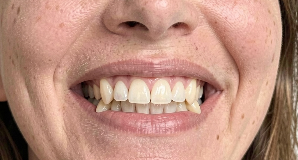 Protruding teeth Correction
