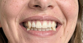 Protruding teeth Correction