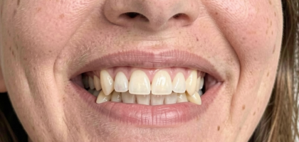 Protruding teeth Correction