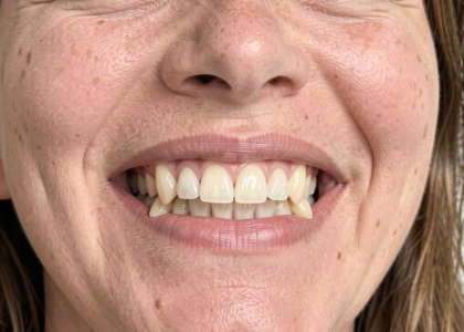 Protruding teeth Correction