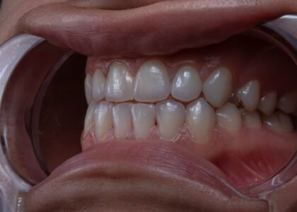 Toothache Reason and How to Prevent Them