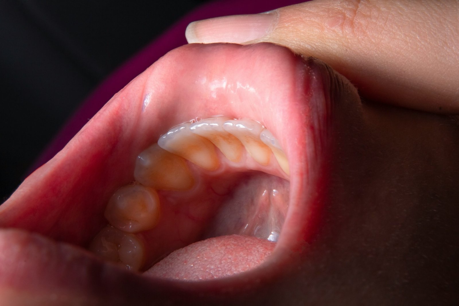 warning signs of oral cancer Symptoms 
