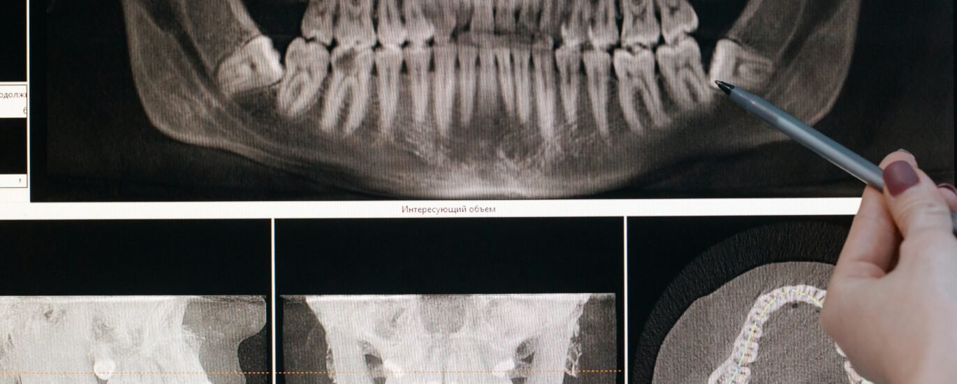 Oral Cancer Symptoms